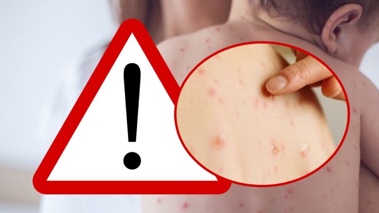 3 decese inregistrate  în judeţul Giurgiu, din cauza Rujeolei!