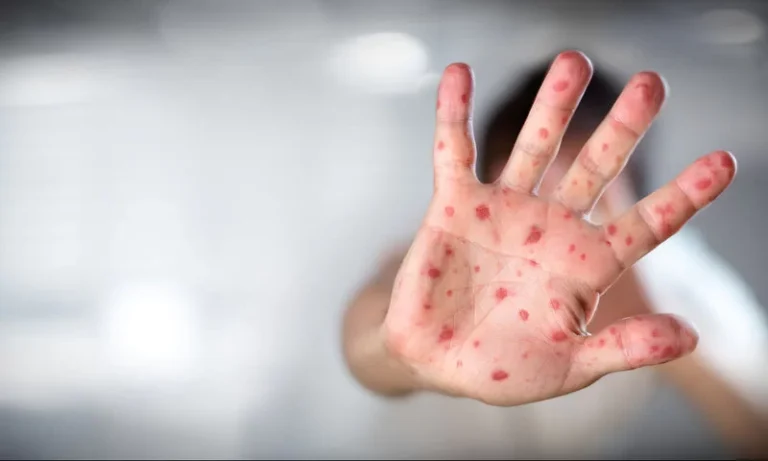 Rujeola a făcut 3 victime în județul Giurgiu, de la începutul acestui an.